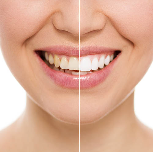Patientin mit hellen Zähnen nach dem Bleaching