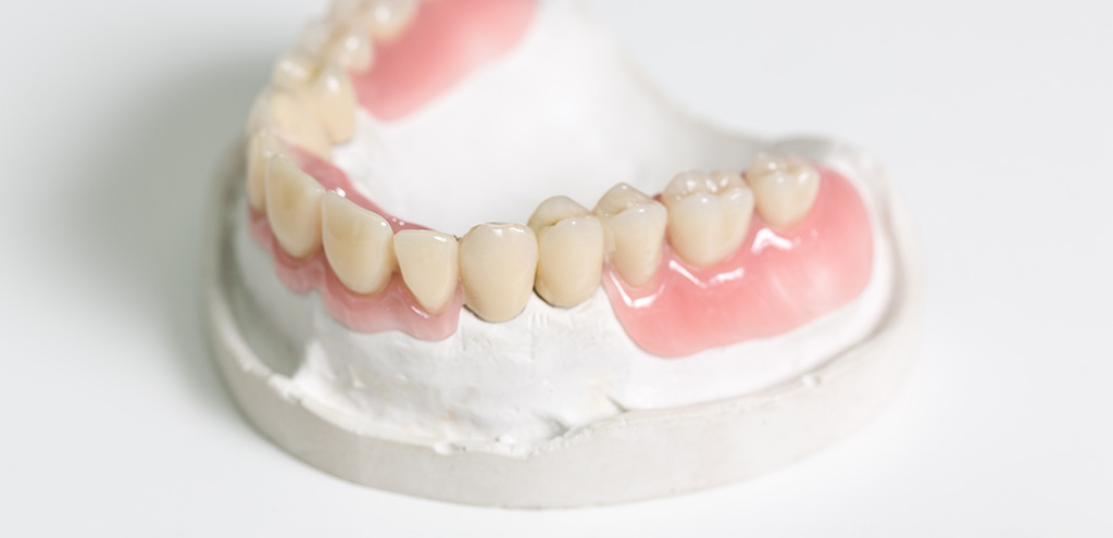 Modell Gipsabdruck mit Zahnprothesen