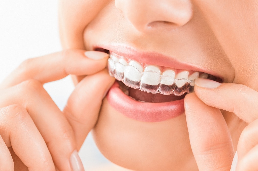 Zufriedene Patientin mit einer unsichtbaren Zahnschiene