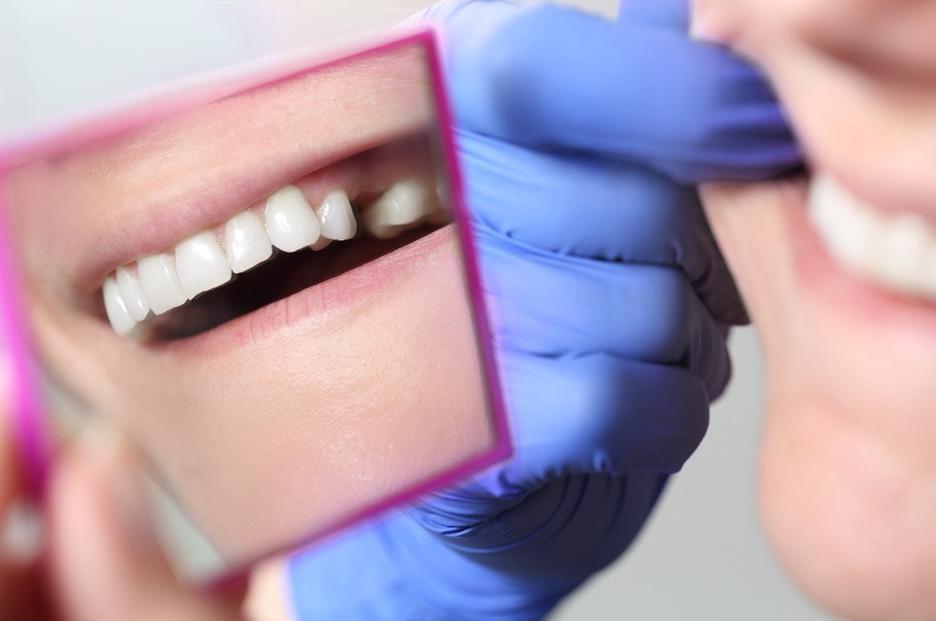 Patientin mit Zahnlücke im Spiegel beim Zahnarzt