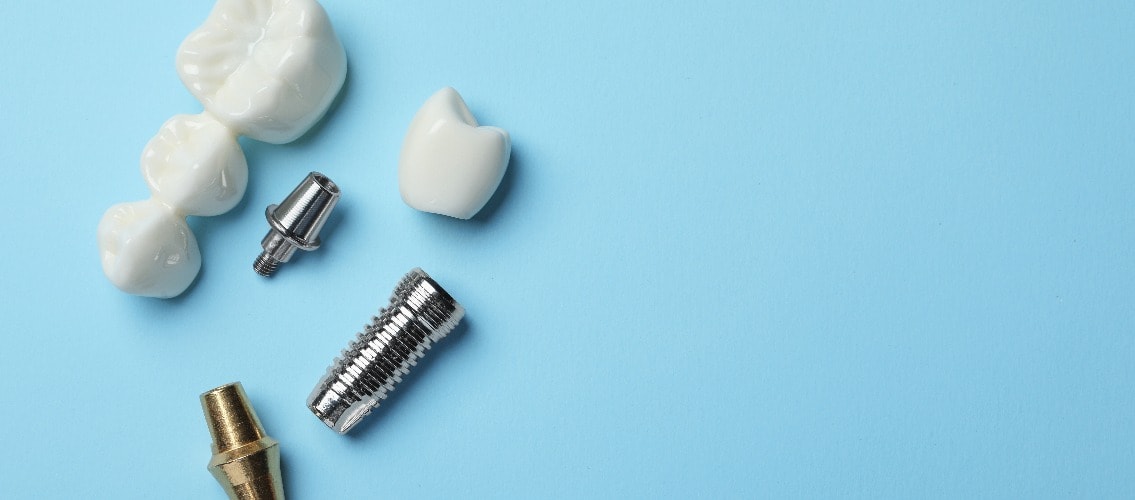 Unterschiede zwischen Zahnbrücke und -implantat