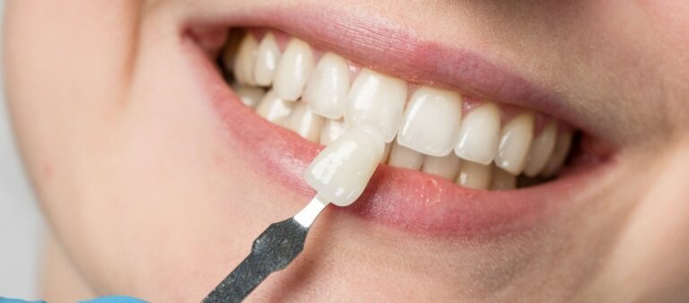 Einsatz von Veneers mit lächelndem Mund