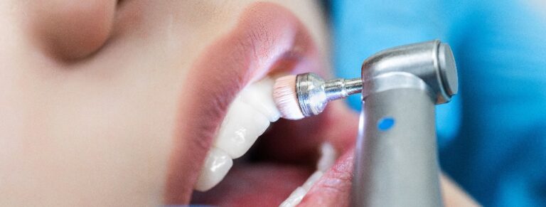 Nahaufnahme von Zähnen mit Zahnputztechnik in der Zahnarztpraxis.