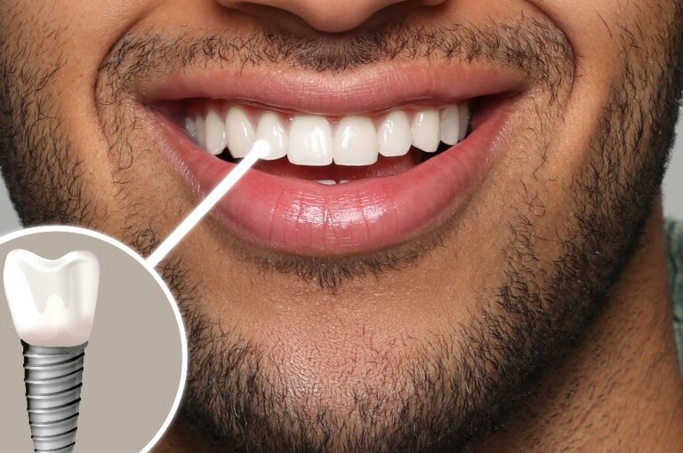 Glücklicher Mann mit perfekten Zähnen lächelnd auf grauem Hintergrund, Nahaufnahme. Illustration eines Zahnimplantats