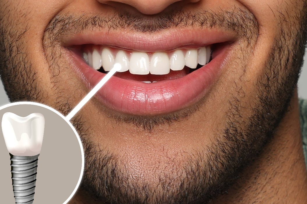 Glücklicher Mann mit perfekten Zähnen lächelnd auf grauem Hintergrund, Nahaufnahme. Illustration eines Zahnimplantats