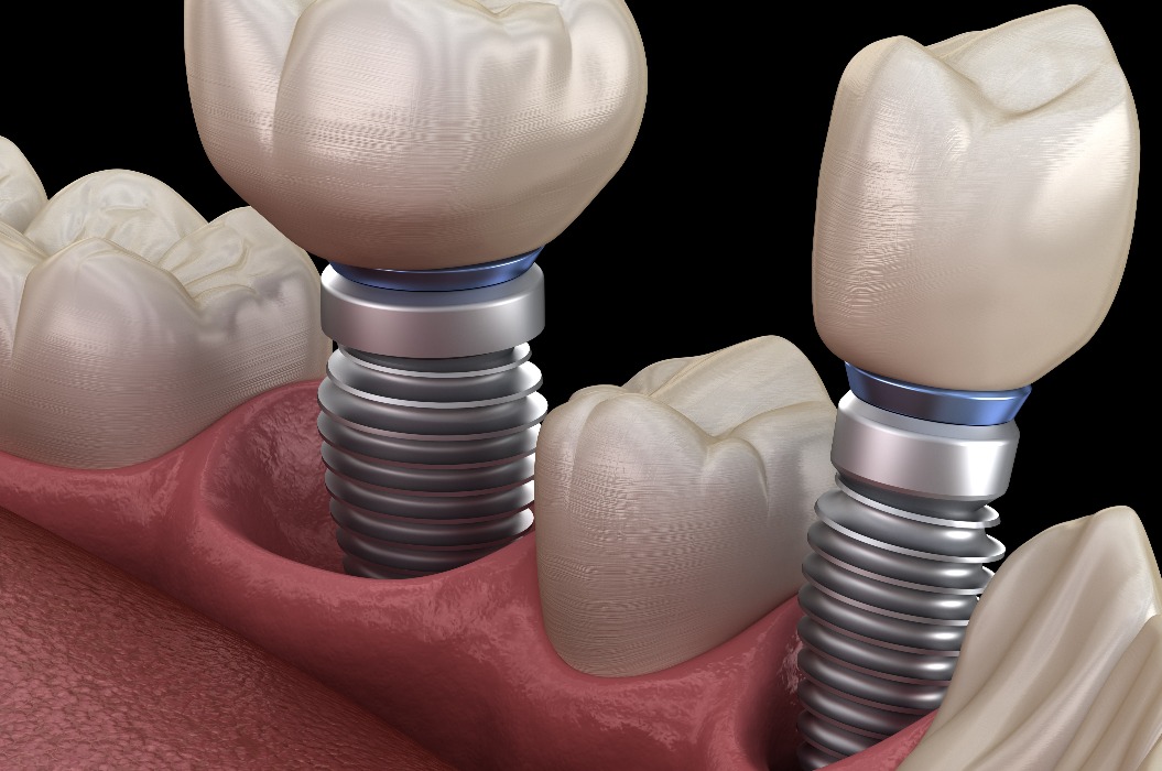 Installation einer Zahnkrone für Prämolaren und Molaren über Implantatpfeilern. Medizinisch exakte 3D-Illustration von menschlichen Zähnen und Zahnersatzkonzepten