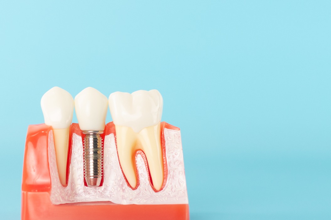 Zahnimplantatmodell auf blauem Hintergrund.